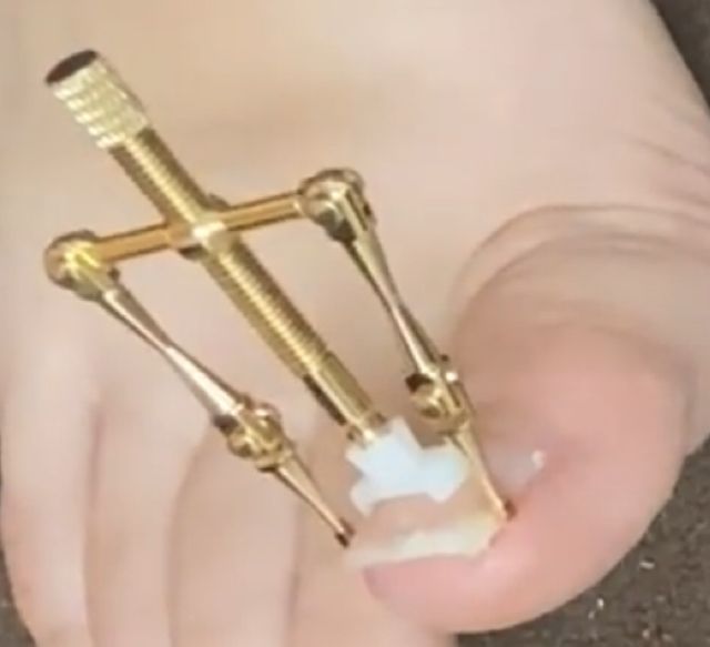 巻き爪ツール Ominail Net