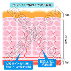セルライトが発生した皮下組織の断面図 広告素材 ｃｏｍ